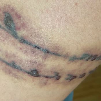 Elit. Lazertasarim Elit Güzellik Merkezi (Aydın) Dövme Silme Yanık