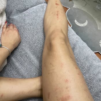 Esteasil Estetik Ve Güzellik Merkezi Lazerde Yandım