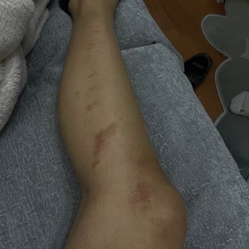 Esteasil Estetik Ve Güzellik Merkezi Lazerde Yandım