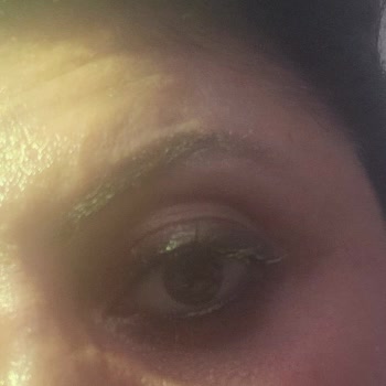 Estelite Medikal Estetik Merkezi İlgisizliği, Kaşsız Kaldım Neredeyse!