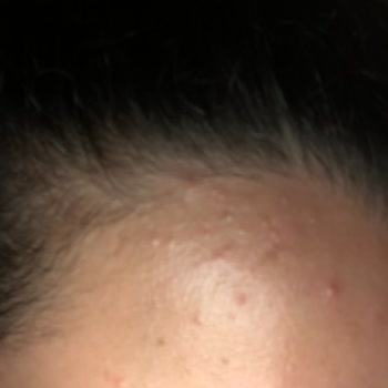 Restorex Şampuandan Kaynaklı Problem