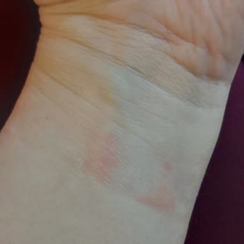 Huawei Watch Fit 2 Kordon Alerjisi