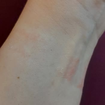 Huawei Watch Fit 2 Kordon Alerjisi