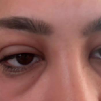 Watsons Ve The Purest Yüzümü Mahvetti Ve Asla Yardımcı Olmadılar