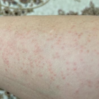 Isana Üre İçerikli Krem Alerji Yaptı