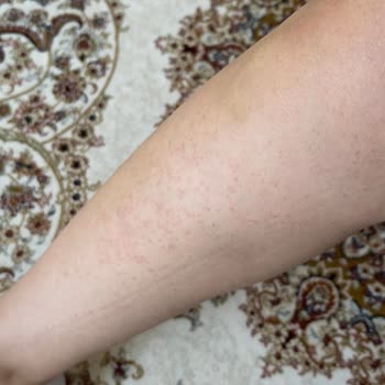 Isana Üre İçerikli Krem Alerji Yaptı