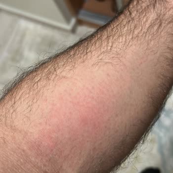 Deepclean Kristal Epilatör cildimi Tahriş Etti