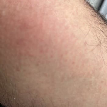 Deepclean Kristal Epilatör cildimi Tahriş Etti