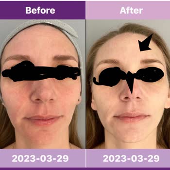 Fatma Süha Beauty Frozen Face Ve Eyes Hiçbir Etki Olmadı