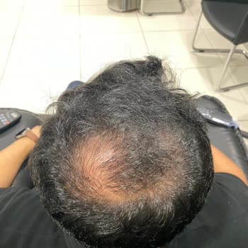 Esteworld Saç Lazeri Ve PRP Başarısız