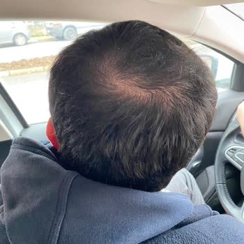 Esteworld Saç Lazeri Ve PRP Başarısız