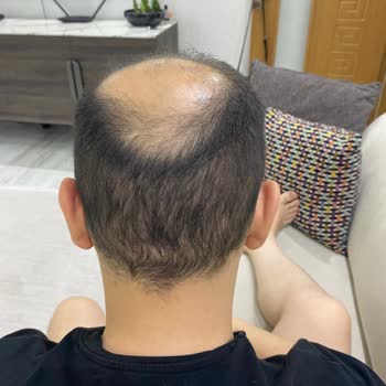 Academic Hospital Başarısız Saç Ekimi