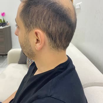 Academic Hospital Başarısız Saç Ekimi