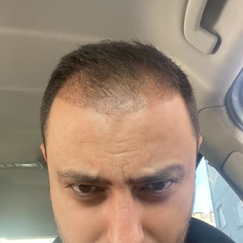 Academic Hospital Başarısız Saç Ekimi