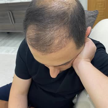 Academic Hospital Başarısız Saç Ekimi