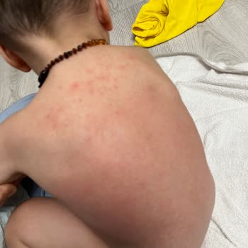 Dalin Bebek Yağı Alerji Yaptı