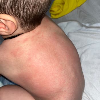 Dalin Bebek Yağı Alerji Yaptı