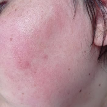 Bioderma Yüzüm Kızardı Kabardı Mahvoldu