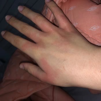 Tereson Sprey Cildimi Tahriş Etti