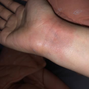 Tereson Sprey Cildimi Tahriş Etti