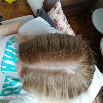 Kuaför Ramazan Nacir Saç Boyama İşlemi Sonrası Alerji Ve Kötü Görünüm