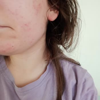 Cream Co. Nemlendirici Sivilce Yaptı