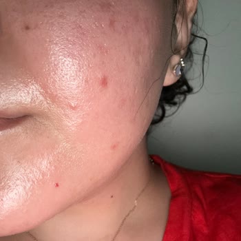 A101 Dkderm Kağıt Maskeleri Cildimde Alerjiye Sebep Oldu