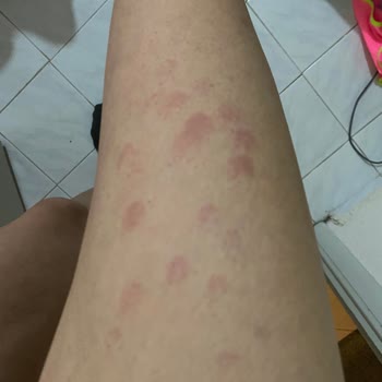 Novar Poliklinik Lazer Şansında Vücut Yanığı