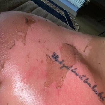 Eda Taşpınar Vücuttaki 3. Derece Yanık!