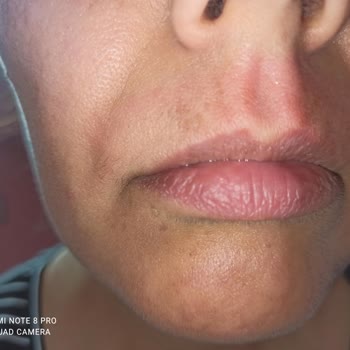 BİM Remove Rool On Ağdanın Ciltte Acayip Tahriş Ve Yanık Yapması