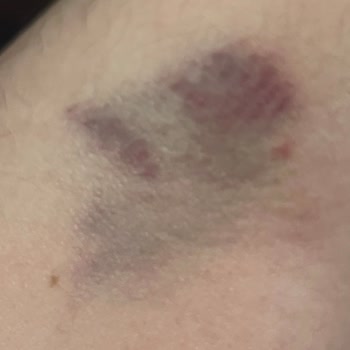 Medipol Sağlık Grubu Medipol Mega Bağcılarda Damarım Patlatıldı Kolum Mosmor Oldu