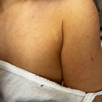 Uni Baby Şampuan Kızımda Alerji Ve Kaşıntı Yaptı