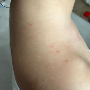 Uni Baby Şampuan Kızımda Alerji Ve Kaşıntı Yaptı