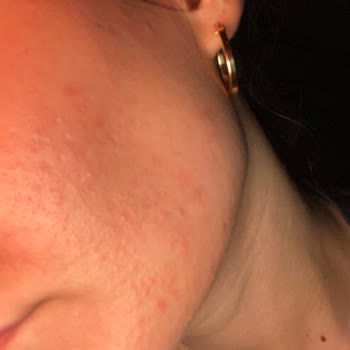 Maruderm Maruz-derm Markası Alerji Yaptı