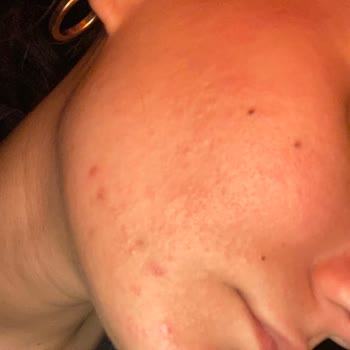 Maruderm Maruz-derm Markası Alerji Yaptı