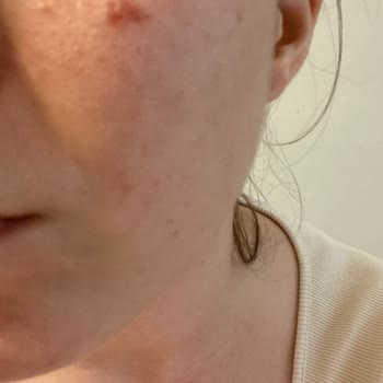 Selin Beauty Dragos Şube Cilt Bakımı (Pumpkin Peel) Mağduriyeti