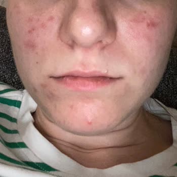 Selin Beauty Dragos Şube Cilt Bakımı (Pumpkin Peel) Mağduriyeti