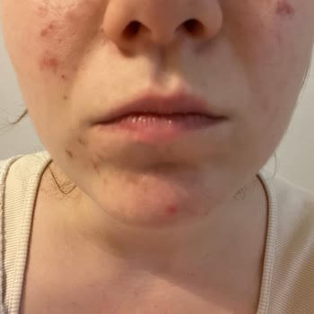 Selin Beauty Dragos Şube Cilt Bakımı (Pumpkin Peel) Mağduriyeti