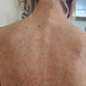 Abdi İbrahim Factive Yan Etkisi