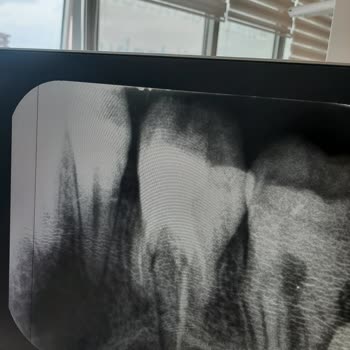 Murat Altun Ağız Ve Diş Sağlığı Polikliniği Kanal İçinde İğne Kırıp Durumu Bildirmedi