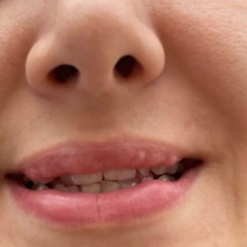 Burcu Beauty Center Fda Onaysız Dudak Vitami Kullandı!