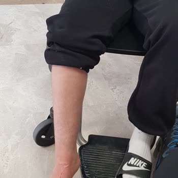 Kaş Tıp Merkezi Alçı Kesimi Sırasında Ayağı Kesmek