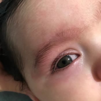 Uni Baby Kızarıklık Ve Şişkinlik