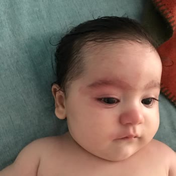 Uni Baby Kızarıklık Ve Şişkinlik