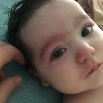 Uni Baby Kızarıklık Ve Şişkinlik