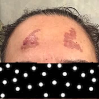 Amerikan Hastanesi (İstanbul) Qswitch Lazer İle Leke Tedavisi Memnuniyetsizliği