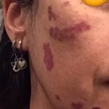 Amerikan Hastanesi (İstanbul) Qswitch Lazer İle Leke Tedavisi Memnuniyetsizliği