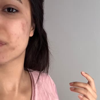 Sesu Cildimde Yanıklar Ve Lekeler Oluştu