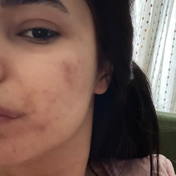 Sesu Cildimde Yanıklar Ve Lekeler Oluştu