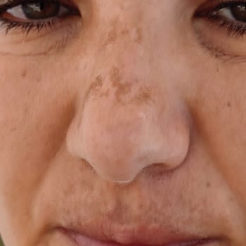 Solante Pigmente Krem Orijinal Ürün Leke Sorunu